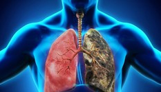 Cảnh báo 5 loại ung thư nguy hiểm có tính di truyền qua nhiều đời