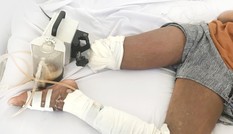 Bé gái 13 tuổi phải cắt bỏ chân vì nhờ thày lang vườn trị rắn cắn