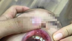 Điểm nhấn giáo dục: Cô giáo ở Hà Nội tát trẻ bầm dập, tụ máu môi