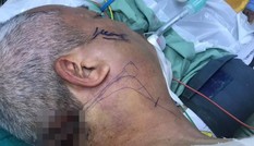 Ngã từ tường rào, người đàn ông bị thanh sắt cắm xuyên cổ