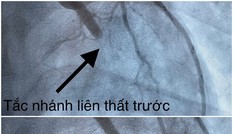 23 tuổi, nam thanh niên đột quỵ vì hút thuốc và nhậu trong nhiều năm