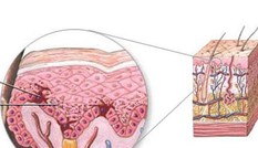 Tẩy vết sẹo thâm, dùng thuốc gì?