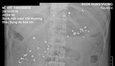 Cành cây mục rơi vào khẩu súng, nam thanh niên bị đạn xuyên 15 lỗ trong dạ dày