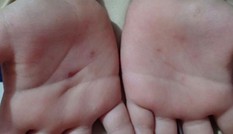 Bản tin 8H: Không nghe lời, bé 5 tuổi nghi bị cô giáo dùng vật nhọn đâm tay