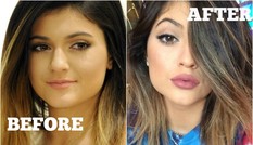 Tại sao mọi người đều tiêm filler làm đầy môi? Những khao khát dấu đằng sau mốt môi dày