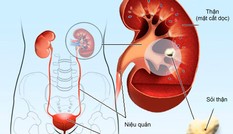 Ngăn ngừa biến chứng khó lường của sỏi tiết niệu