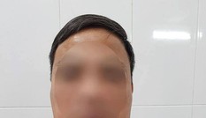 Bợm nhậu cổ phình to như bướu lạc đà vì 'xơi' 1 lít rượu mỗi ngày