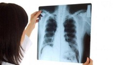 Người phụ nữ ung thư phổi di căn dù chỉ có dấu hiệu khó thở, tức ngực
