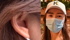 Vào viện thẩm mỹ để sửa mũi, cô gái sốc khi phát hiện ra đã bị cắt mất một phần tai