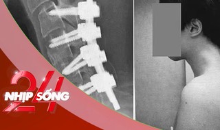 NHỊP SỐNG 24: Thanh niên mắc ‘hội chứng rụng đầu' vì dùng điện thoại