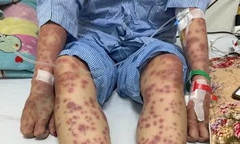 Suýt mất mạng vì 'thuốc giảm cân, collagen thải độc'
