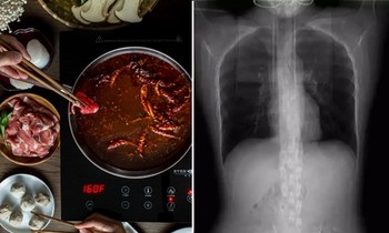 Một cô gái Trung Quốc ăn cay xong bị ho đến mức gãy 4 xương sườn, bác sĩ giải thích ra sao?