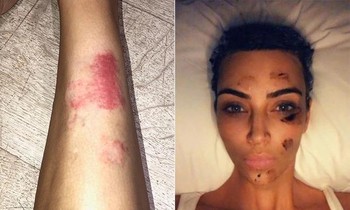 Giảm 7 kg để mặc vừa váy của Marilyn Monroe, Kim Kardashian tiết lộ hậu quả đáng sợ