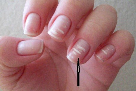 Móng tay và các dấu hiệu bệnh