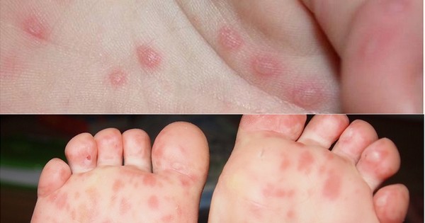 Bệnh tay chân miệng ở trẻ em có nguy hiểm không?
