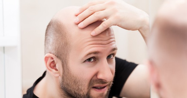 Nhổ tóc có mọc lại được không? Những điều cần biết để không bị hói đầu