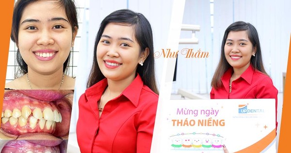 Việc niềng răng đẹp sẽ mang lại nhiều lợi ích không chỉ cho sự tự tin về ngoại hình mà còn cho sức khỏe nha khoa và tư duy.