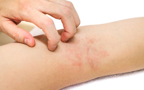 Thực phẩm có ảnh hưởng đến bệnh eczema hay không? 
