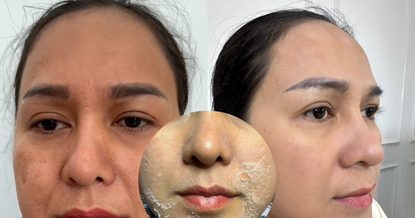 Sử dụng Retinol Mix Peel có gây kích ứng da hay không?
