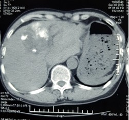 Có những yếu tố gì tăng nguy cơ khối u gan bị vỡ?
