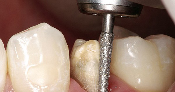 Quy trình mài răng trước khi trồng răng sứ như thế nào?
