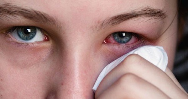 Thuốc giảm đau mắt có tác dụng phụ không?
