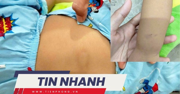 TIN NHANH: Đình chỉ cơ sở giữ trẻ sau vụ bé gái hơn 2 tuổi bị chấn thương 'vùng kín'