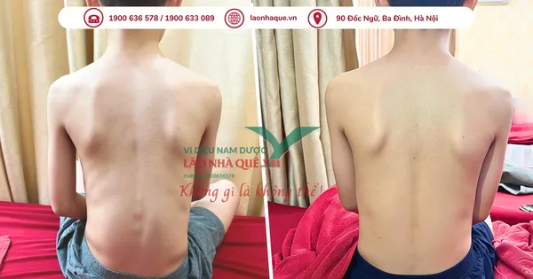 Phương pháp 'Khai thông cột sống' hỗ trợ điều trị đau do thoái hóa khớp tại Lão Nhà Quê