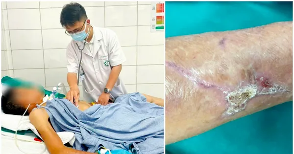 Cứng hàm, suy hô hấp vì vết xước nhỏ, cảnh báo 'đặc biệt' từ hai ca uốn ván nặng