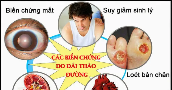 Biến chứng kép tim mạch – võng mạc ở bệnh nhân tiểu đường: Có thể ngăn chặn từ sớm