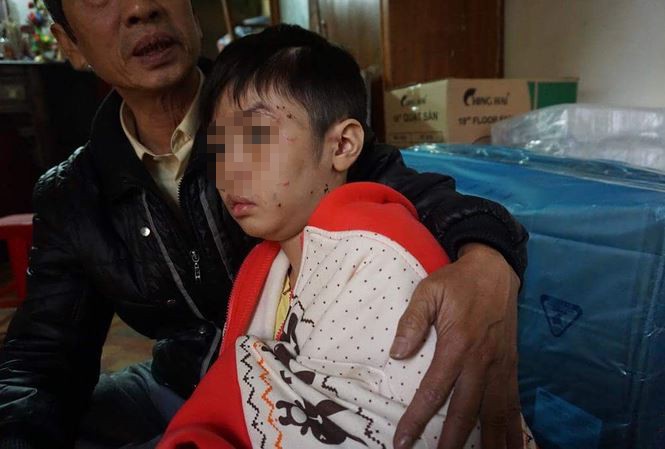 Bé trai 10 tuổi kể lại những 'trận đòn chí tử' của bố đẻ Cháu K vẫn chưa hết sợ hãi từ những trận đòn của bố, hiện đang về ở cùng mẹ.
