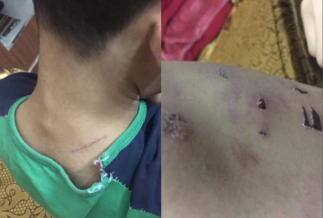 Bé 9 tuổi bị đánh tím người: Mẹ cháu bé chấp nhận hòa giải Vết thương trên người cháu N.