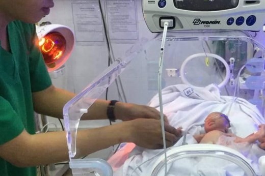 Bé gái nặng 1,3kg, suy hô hấp nặng vì sinh thiếu tháng Đây là trường hợp sinh non thứ 2 tại BV Quận Thủ Đức từ đầu năm đến nay.