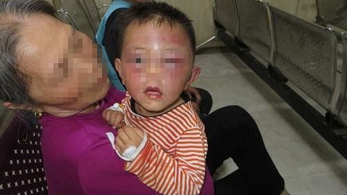 Không truy cứu trách nhiệm hình sự cha dượng đánh bé 2 tuổi nhập viện Cháu H. bị bố dượng bạo hành phải nhập viện điều trị