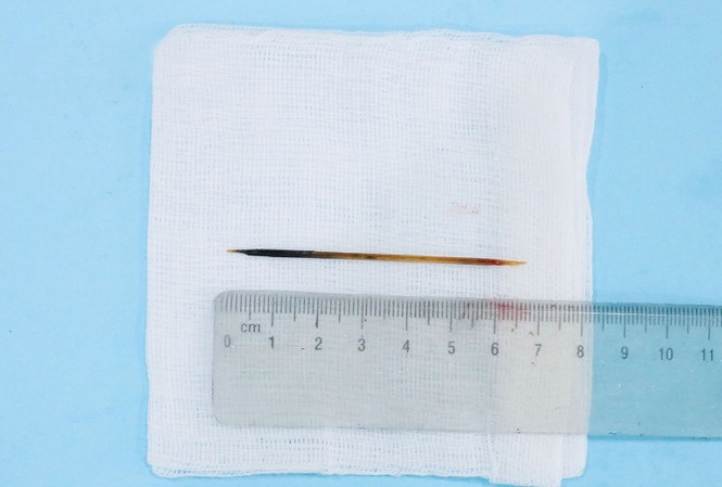 Hi hữu: Người đàn ông ngủ quên, nuốt tăm 7cm vào bụng Hi hữu: Người đàn ông ngủ quên, nuốt tăm 7cm vào bụng