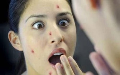 Làm gì khi nhà có người bị thủy đậu? Làm gì khi nhà có người bị thủy đậu?