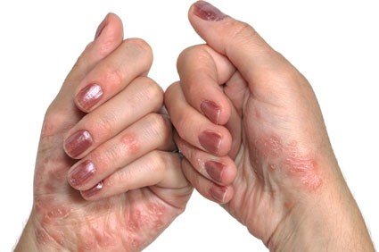 Bệnh nhân vảy nến có nguy cơ cao mắc bệnh tiểu đường týp 2 Ảnh minh họa