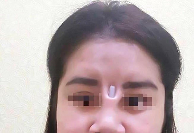 Bị thanh silicone đâm thủng mũi chòi ra giữa mặt Bị thanh silicone đâm thủng mũi chòi ra giữa mặt
