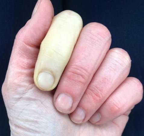 Ngón tay trắng bệch cảnh báo bệnh nguy hiểm Hình ảnh ngón tay trắng bệch do bệnh Raynaud. Ảnh: Jenni Falconer.