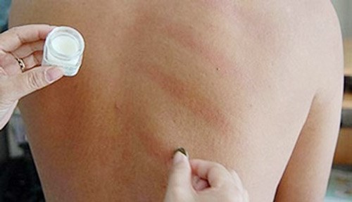 Cạo gió cũng có 'chống chỉ định' Ảnh minh họa