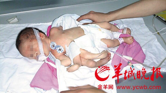 Em bé tám chân tay ở Trung Quốc Em bé tám chân tay ở Trung Quốc