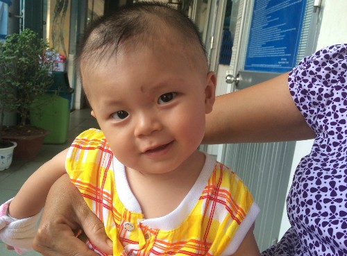 Bé bị đâm xuyên não tròn 9 tháng tuổi Bé sẽ được theo dõi sát trong 3 năm đầu đời. Ảnh: Lê Phương.