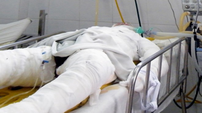 Tán em gái người tình không được, dùng xăng đốt nạn nhân Chị Hồng nằm viện điều trị cách đây một năm do bị tạt bom xăng