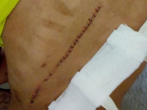 Khánh Hòa: Thiếu nữ bị rạch lưng dài hơn 10 cm Vết thương trên vùng lưng chị T.