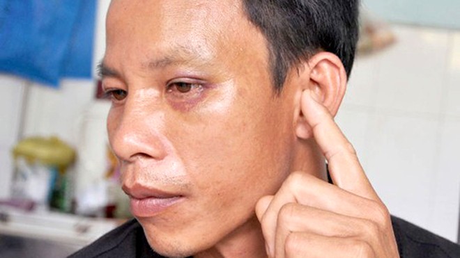 Cho thôi việc công an viên làm dân bị thủng màng nhĩ Anh Hồng bị thủng nhĩ tai trái, bầm mắt