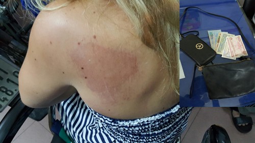 Nữ du khách bị hai người đàn bà kéo lê, cướp túi xách Du khách bị thương tích và tang vật. Ảnh: Quốc Thắng