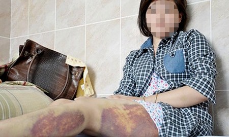 Đánh nghi can để truy xét vụ trộm điện thoại Những vết sưng bầm trên chân chị Thu
