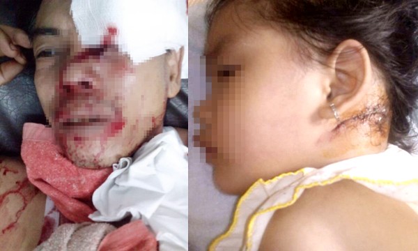 Long An: 2 ông cháu bị thanh niên vác dao chém nhập viện Ông Thiệt với vết thương ở vùng mặt và bé Nguyễn Ngọc Thảo Vy với vết thương sau gáy