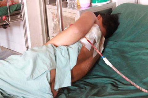 Bị đâm thủng phổi vì yêu cầu chung tiền thua bida Bị bạn dùng dao đâm thủng phổi