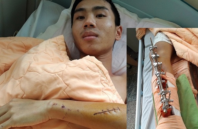 Nam thanh niên bị nhóm côn đồ đánh gãy cả 2 chân Lợi đang nằm điều trị tại bệnh viện - Ảnh: Tây Sơn